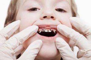Các bệnh răng miệng ở trẻ em