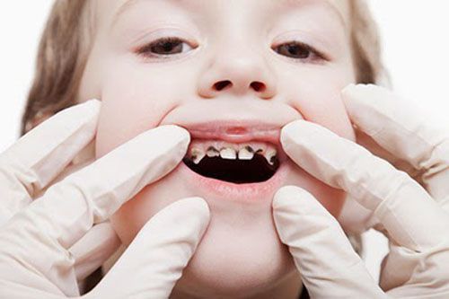 Cách điều trị tủy răng sữa cho trẻ em 1