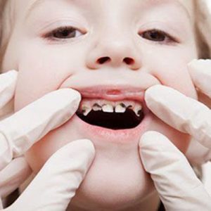 Các bệnh răng miệng ở trẻ em