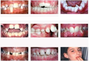 Nguyên nhân răng mọc lệch ở trẻ em và cách khắc phục