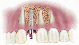 Trồng răng Implant không đau