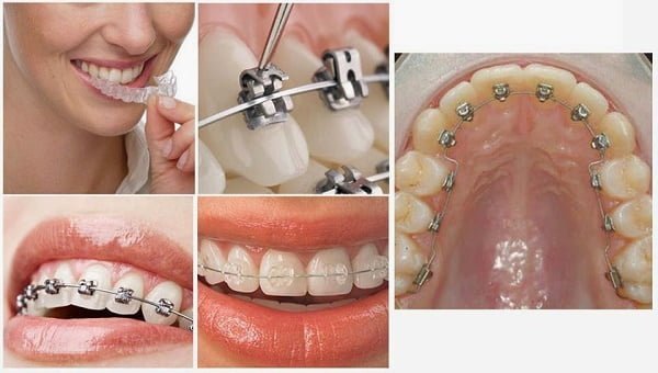 Nẹp răng hiệu quả giúp răng đều đẹp