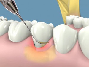 Cạo vôi răng có đau không? 3