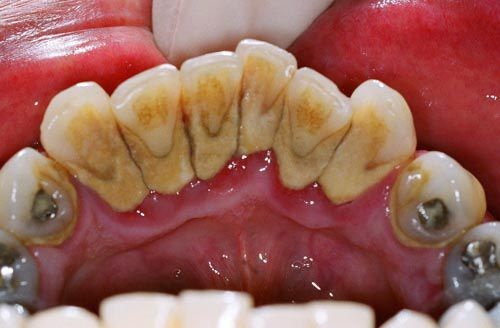Cạo vôi răng có tác dụng gì? 2