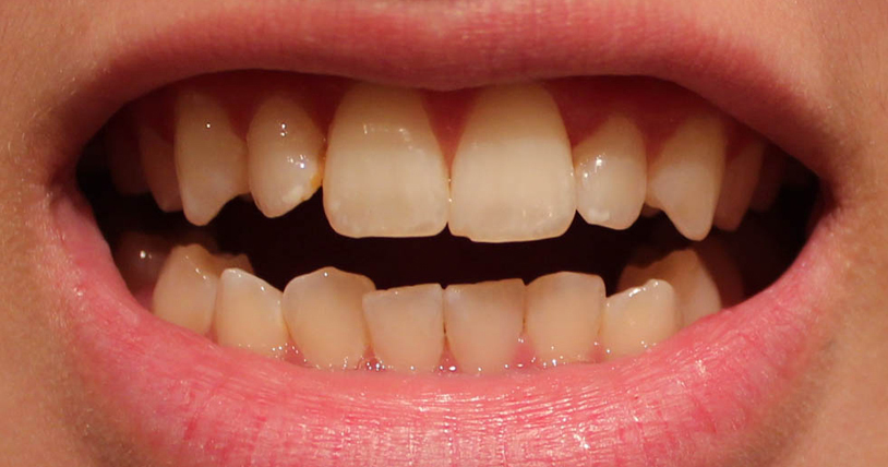 Nên tẩy trắng răng bằng phương pháp nào? 1