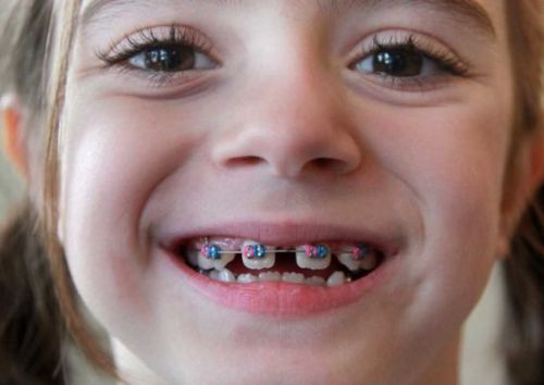 Niềng răng cho trẻ em ở đâu tphcm hiệu quả? 1