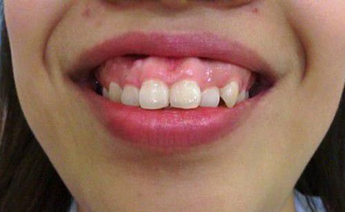 Niềng răng hô hàm trên 1