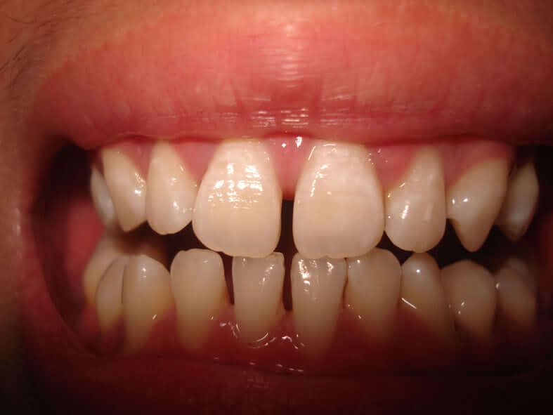 Niềng răng không nhổ răng chỉ áp dụng khi nào? 1