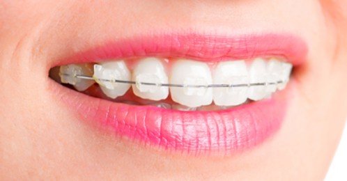 Niềng răng không nhổ răng chỉ áp dụng khi nào? 2