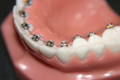 Niềng răng không nhổ răng chỉ áp dụng khi nào? 3