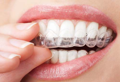 Niềng răng không nhổ răng chỉ áp dụng khi nào? 4