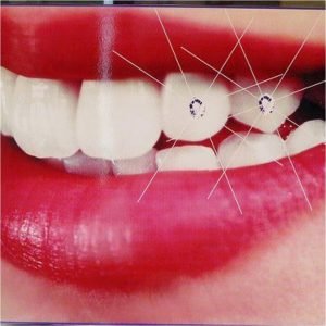Phương pháp tẩy trắng răng có nguy hiểm không? 1