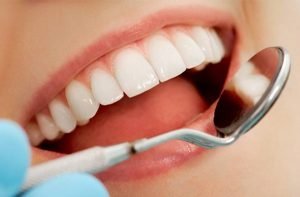 Phương pháp tẩy trắng răng có nguy hiểm không? 2