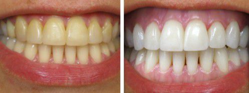 Tẩy trắng răng bằng Laser Whitening bao nhiêu tiền? 1
