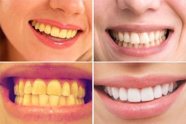Tẩy trắng răng bằng Laser Whitening có hại không? 1
