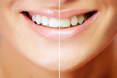 Tẩy trắng răng như thế nào để hiệu quả tốt nhất? 1