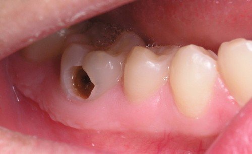 Răng bị sâu có tẩy trắng răng sâu được không? 1