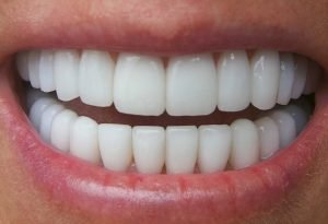 Răng bị sâu có tẩy trắng răng sâu được không? 3
