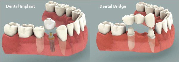 Trồng răng hàm có đau không có nguy hiểm không? 2