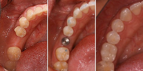 Trồng răng hàm có đau không có nguy hiểm không? 3