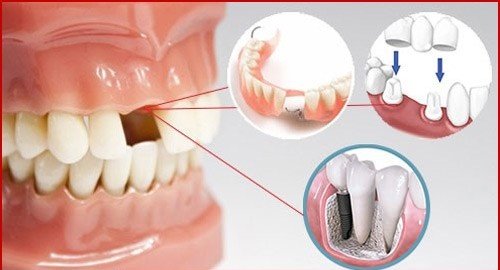 Địa chỉ trồng răng implant tốt nhất ở đâu? 1