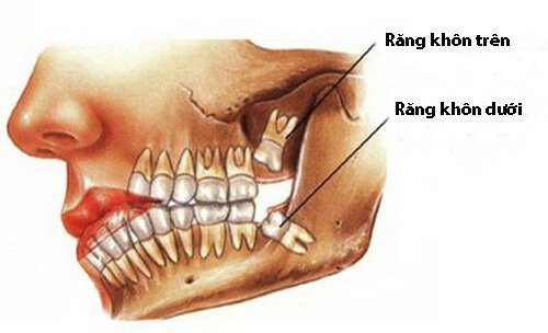 Nhổ răng khôn có đau không có ảnh hưởng đến sức khỏe không? 1