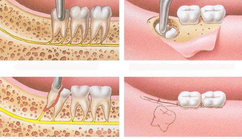 Răng khôn bị mọc lệch gây đau nhức phải làm sao? 3