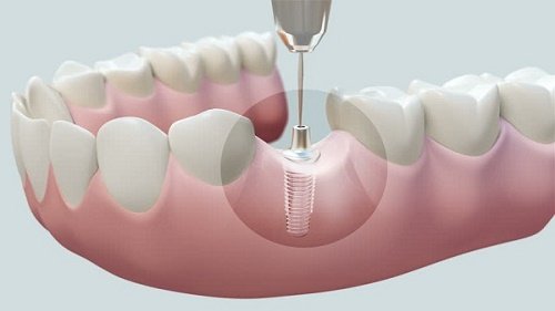 Trồng răng implant có đau không? 1