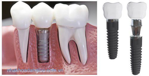 Trồng răng implant có đau không? 3
