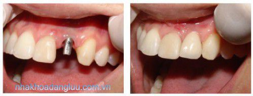 Trồng răng Implant có nguy hiểm không? 1