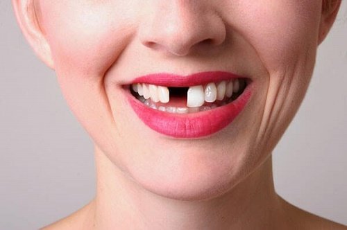 Trồng răng Implant có nguy hiểm không? 2