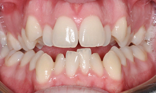 Có nên bọc răng sứ cho răng khấp khểnh? 1