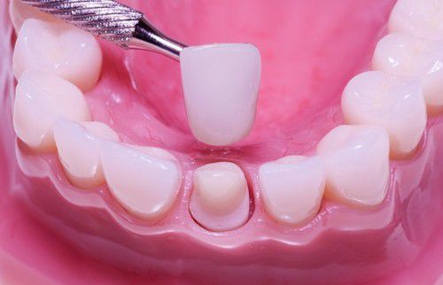Có nên bọc răng sứ cho răng khấp khểnh? 2