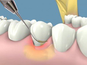 Tìm hiểu vì sao bị chảy máu chân răng và cách điều trị 4