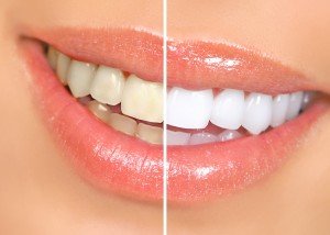 Tẩy trắng răng có an toàn không? 1