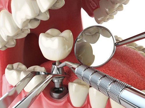 Cấy ghép răng implant là gì? 1