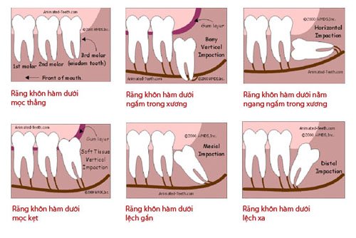Răng khôn là răng nào và có cần giữ lại không? 2