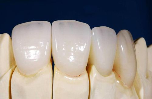 Răng sứ cercon 3