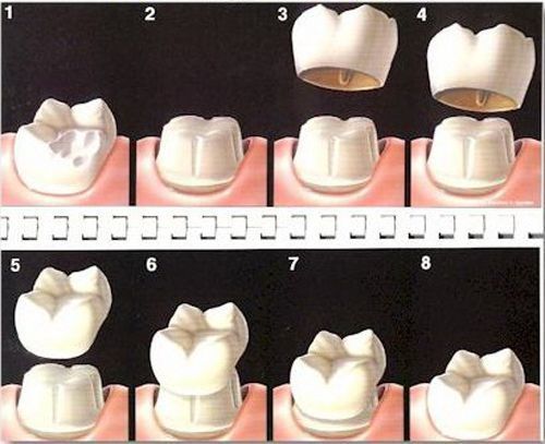 Răng sứ kim loại có tốt không? 3