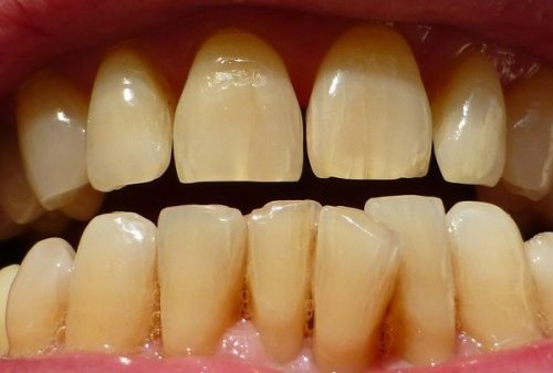 Tẩy trắng răng vĩnh viễn 1