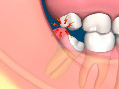 Răng khôn hàm trên mọc lệch 1