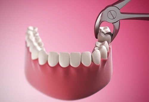 Răng khôn mọc lệch có nên nhổ không? 3