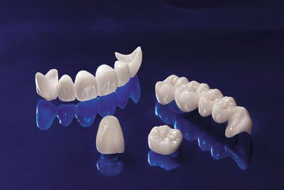 Ưu và nhược điểm của các loại răng sứ 3