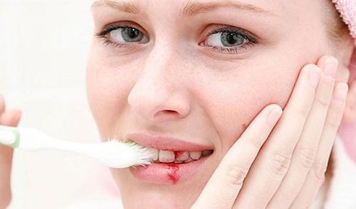Bị chảy máu chân răng nên uống thuốc gì? 1