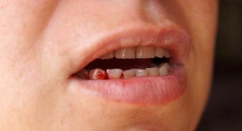 Chảy máu chân răng vào buổi sáng có nguy hiểm không? 1
