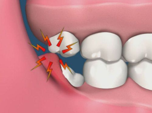 Nhổ răng khôn có ảnh hưởng gì không? 1