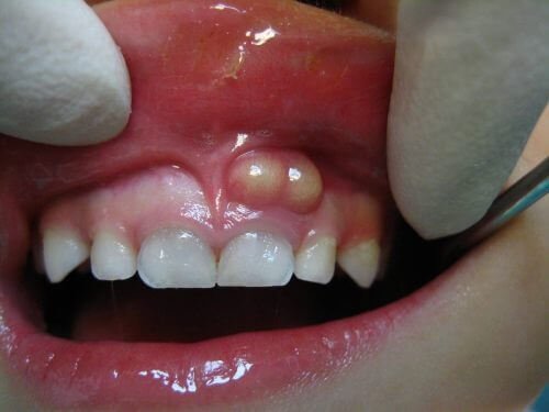Cách điều trị viêm chân răng có mủ an toàn cho bạn 2