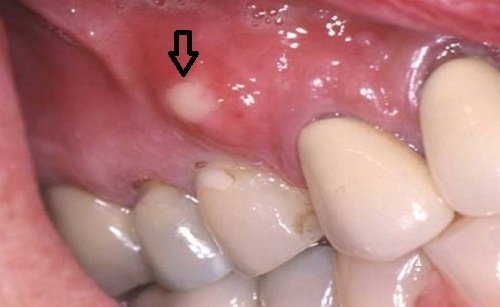 Viêm lợi hở chân răng người bệnh phải làm sao? 1