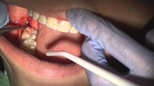 Cắt lợi trùm răng khôn có đau không? Cần tư vấn kỹ vấn đề này 1