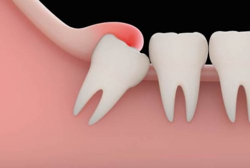 Viêm lợi trùm răng khôn ảnh hưởng như thế nào đến răng? 1